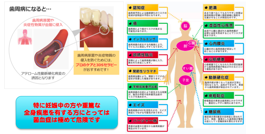歯周病と全身